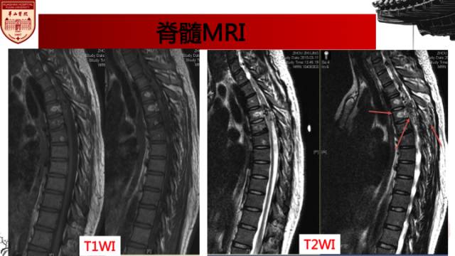 【病例】脊柱节段性血管瘤病(Cobb's综合征)一例MR