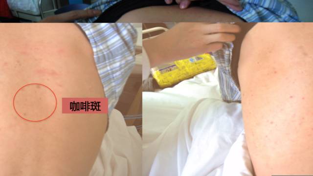 【病例】脊柱节段性血管瘤病(Cobb's综合征)一例MR
