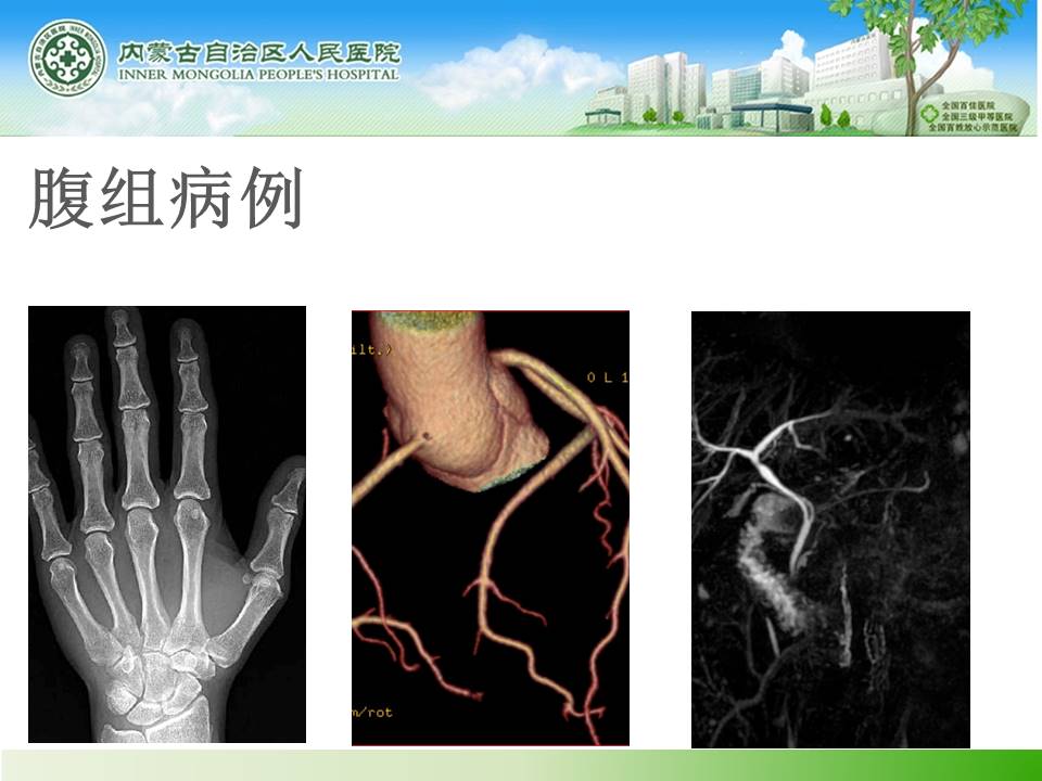 【病例】胰腺神经内分泌肿瘤1例CT
