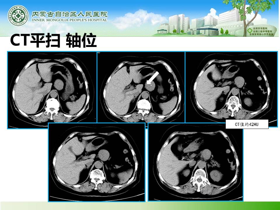 【病例】胰腺神经内分泌肿瘤1例CT