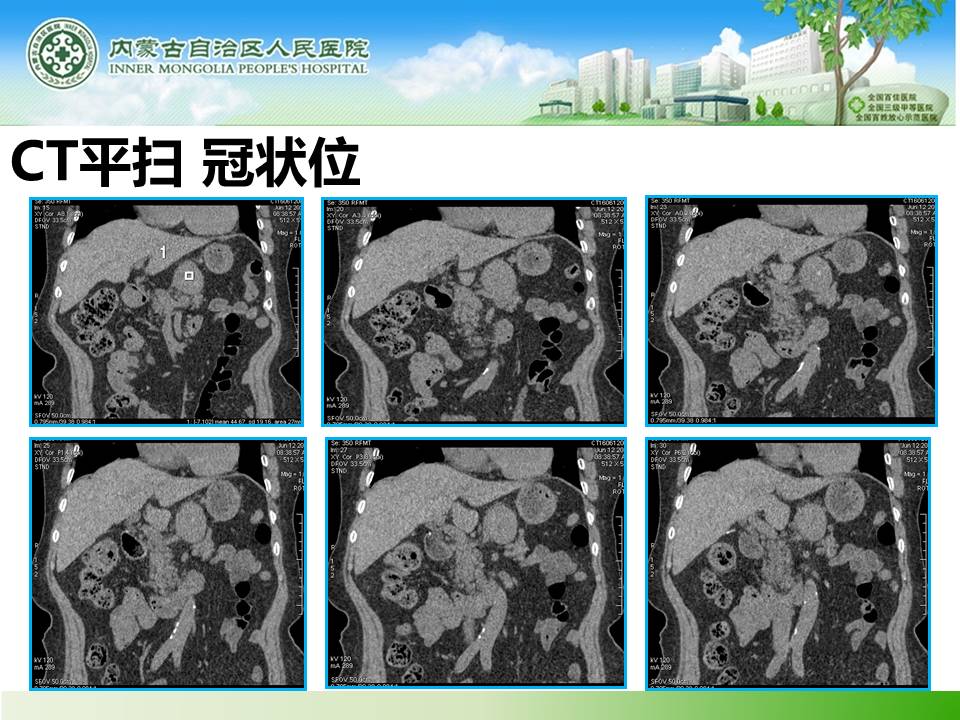 【病例】胰腺神经内分泌肿瘤1例CT