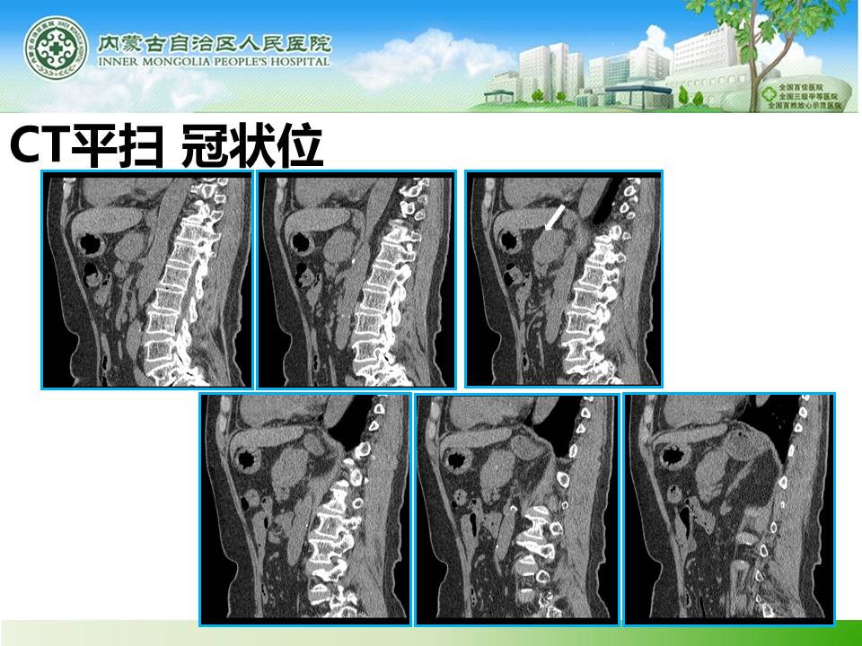 【病例】胰腺神经内分泌肿瘤1例CT