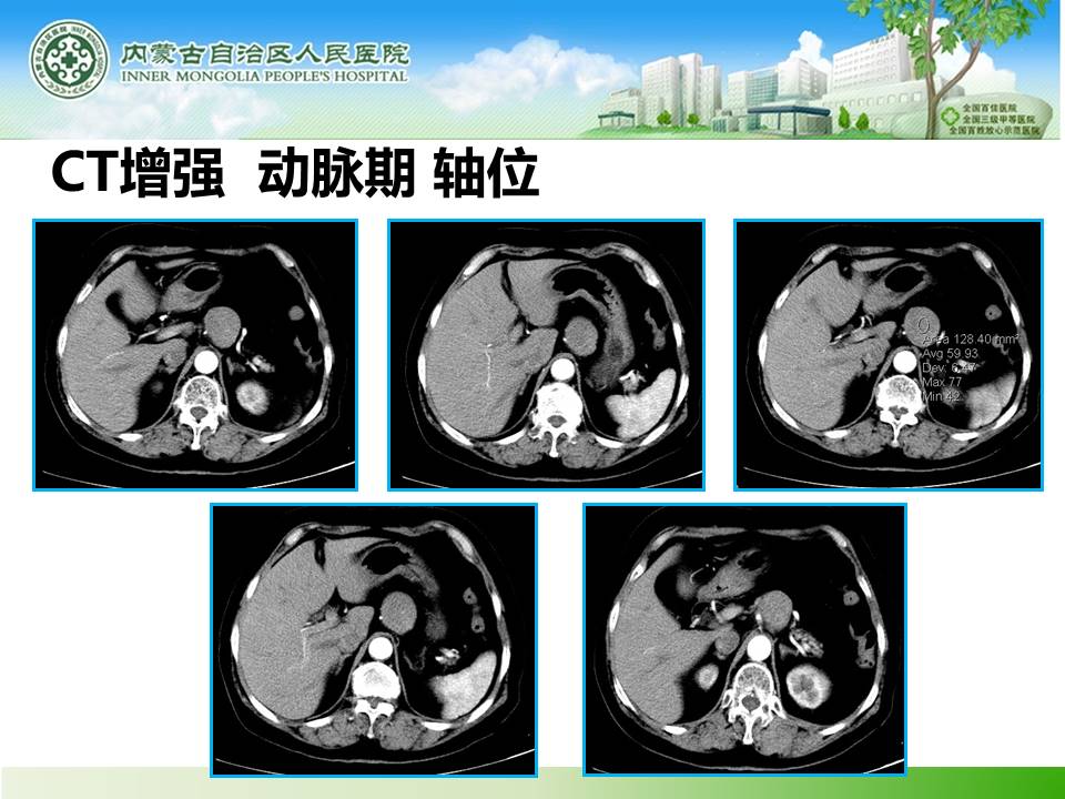 【病例】胰腺神经内分泌肿瘤1例CT