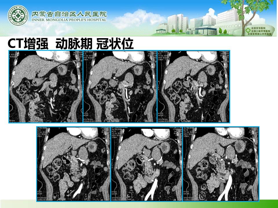 【病例】胰腺神经内分泌肿瘤1例CT