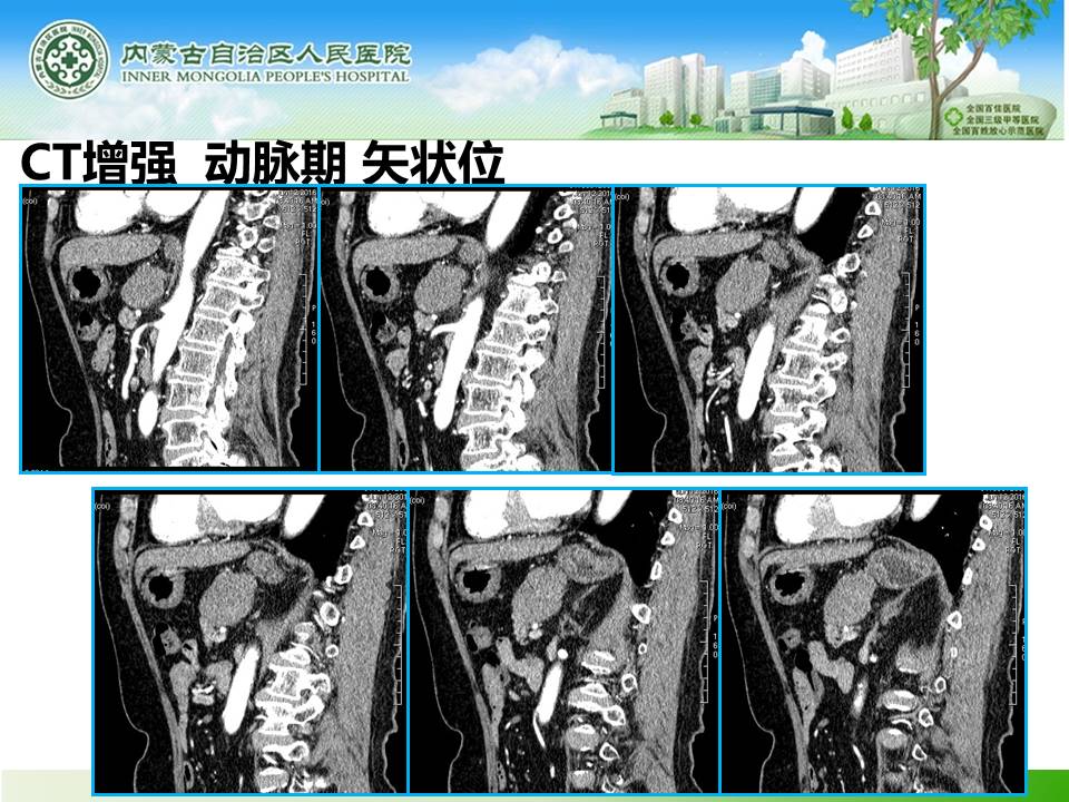 【病例】胰腺神经内分泌肿瘤1例CT