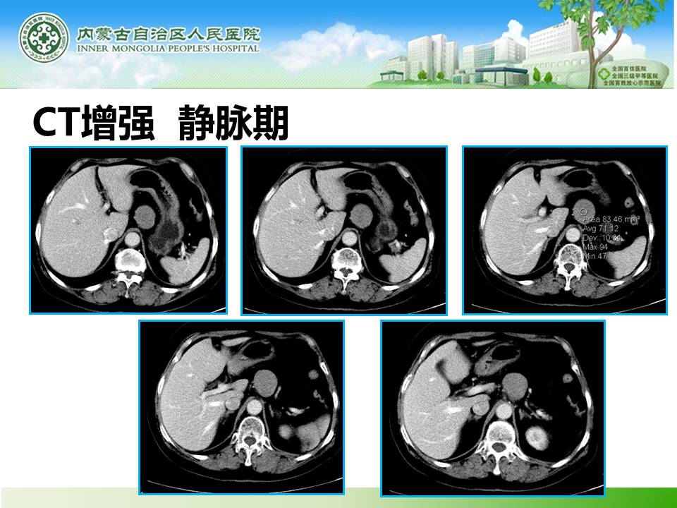 【病例】胰腺神经内分泌肿瘤1例CT