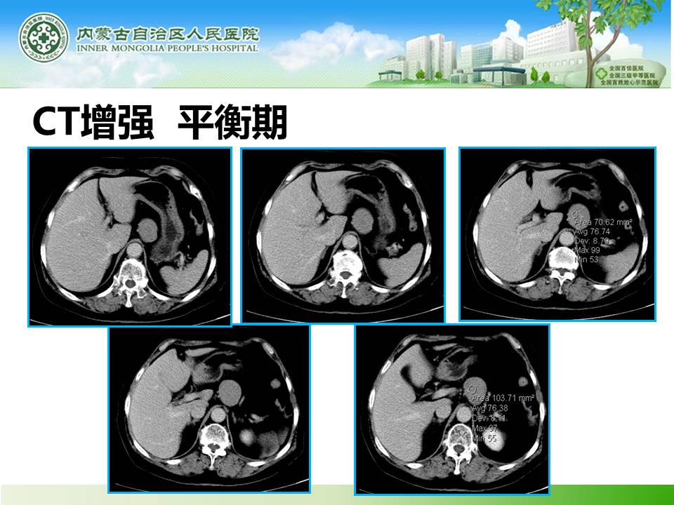 【病例】胰腺神经内分泌肿瘤1例CT