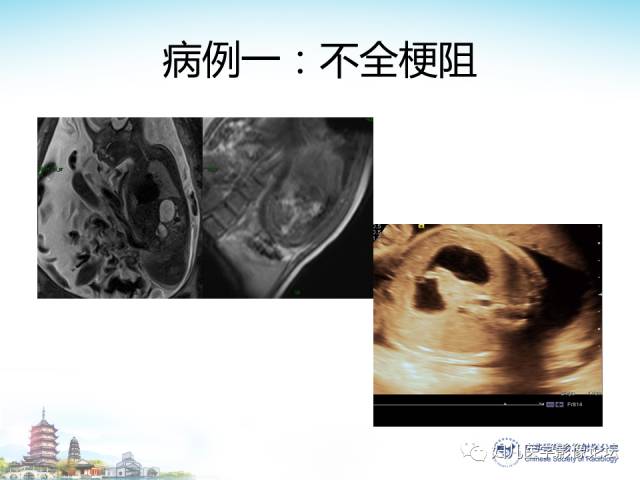 【PPT】胎儿腹部常见囊性病变的MRI诊断及鉴别