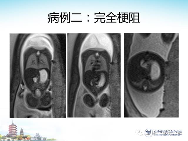【PPT】胎儿腹部常见囊性病变的MRI诊断及鉴别