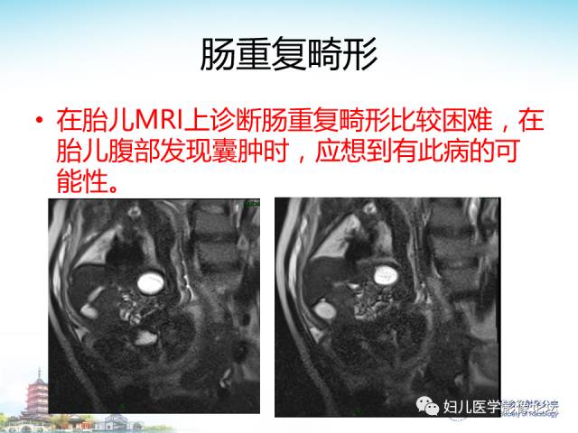 【PPT】胎儿腹部常见囊性病变的MRI诊断及鉴别