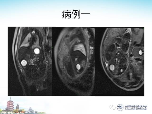 【PPT】胎儿腹部常见囊性病变的MRI诊断及鉴别