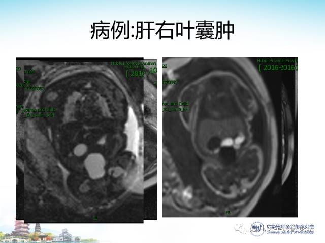 【PPT】胎儿腹部常见囊性病变的MRI诊断及鉴别