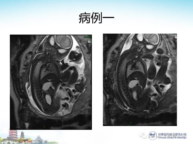 【PPT】胎儿腹部常见囊性病变的MRI诊断及鉴别