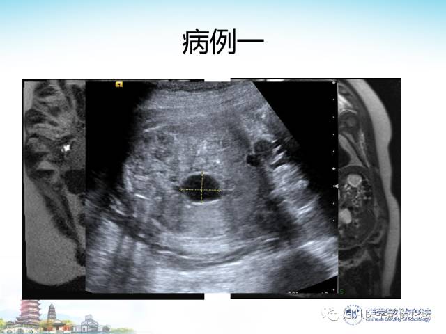 【PPT】胎儿腹部常见囊性病变的MRI诊断及鉴别