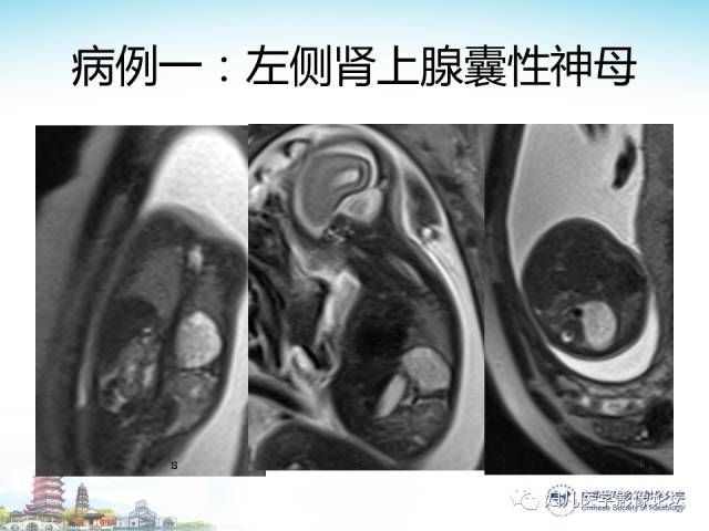 【PPT】胎儿腹部常见囊性病变的MRI诊断及鉴别