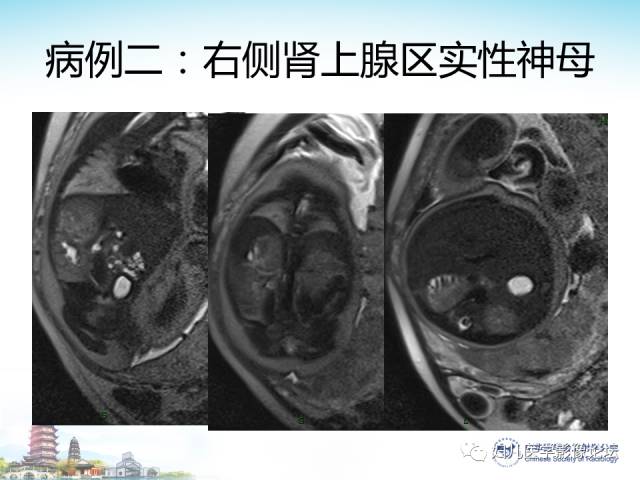 【PPT】胎儿腹部常见囊性病变的MRI诊断及鉴别