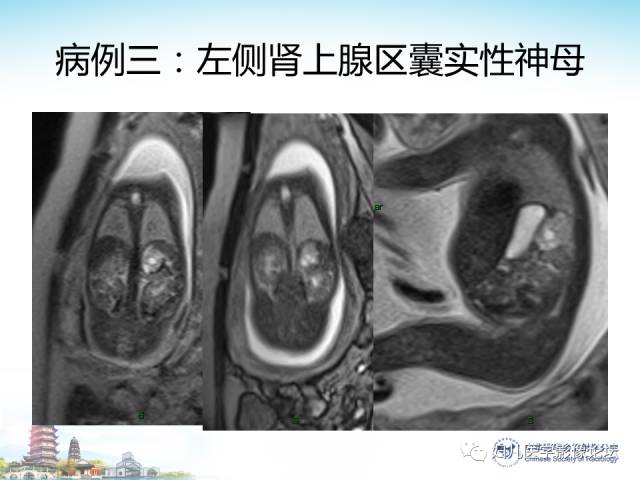 【PPT】胎儿腹部常见囊性病变的MRI诊断及鉴别