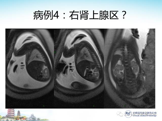 【PPT】胎儿腹部常见囊性病变的MRI诊断及鉴别