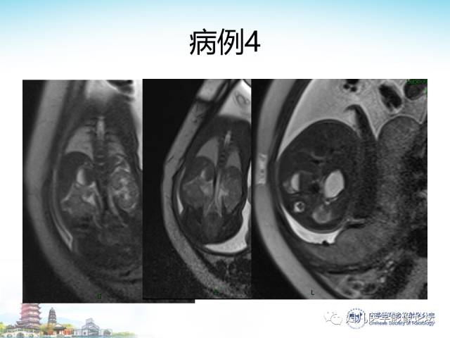 【PPT】胎儿腹部常见囊性病变的MRI诊断及鉴别