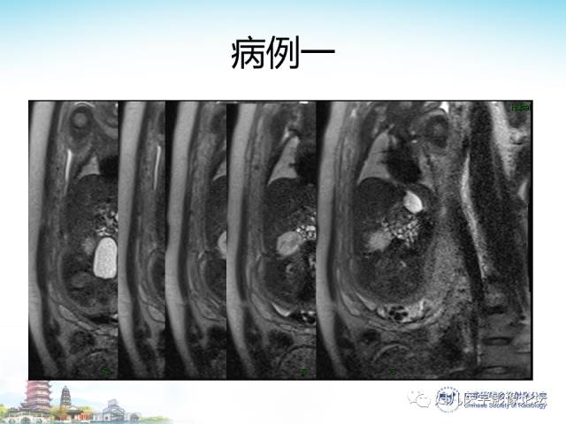 【PPT】胎儿腹部常见囊性病变的MRI诊断及鉴别