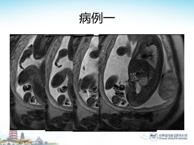 【PPT】胎儿腹部常见囊性病变的MRI诊断及鉴别