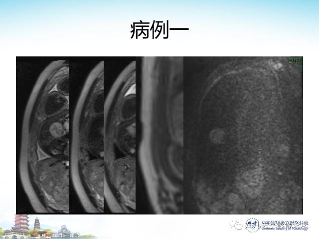 【PPT】胎儿腹部常见囊性病变的MRI诊断及鉴别
