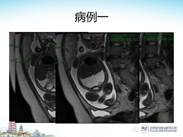 【PPT】胎儿腹部常见囊性病变的MRI诊断及鉴别