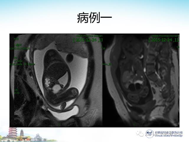 【PPT】胎儿腹部常见囊性病变的MRI诊断及鉴别