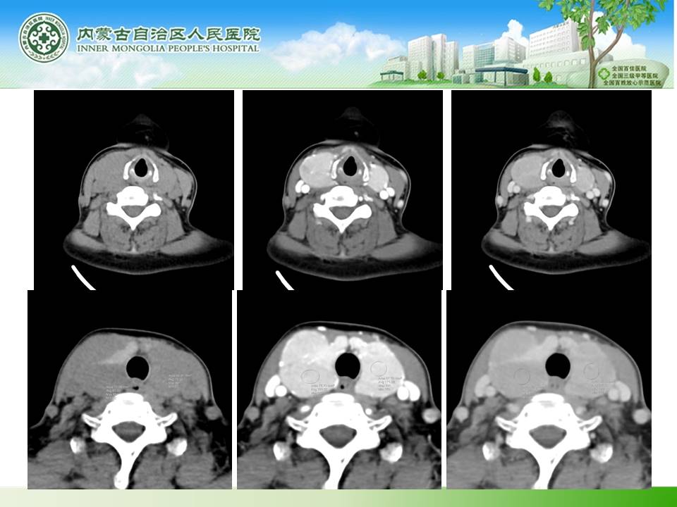 【病例】桥本甲状腺炎1例CT