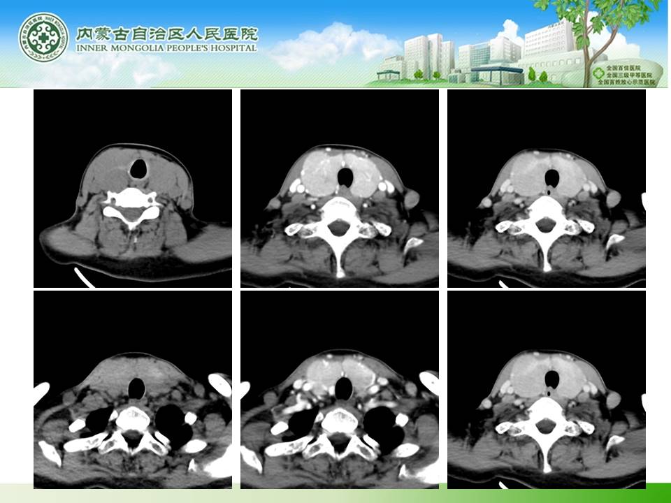 【病例】桥本甲状腺炎1例CT