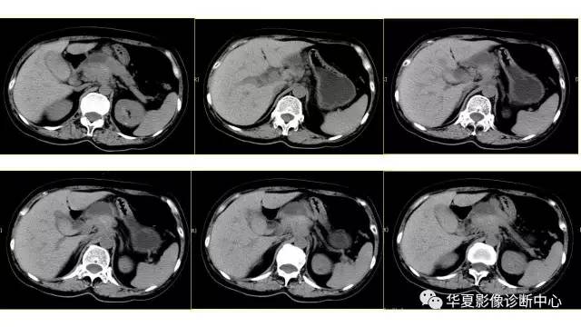 【病例】胰腺癌伴囊变坏死1例CT影像表现