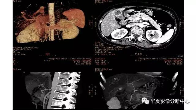 【病例】胰腺癌伴囊变坏死1例CT影像表现