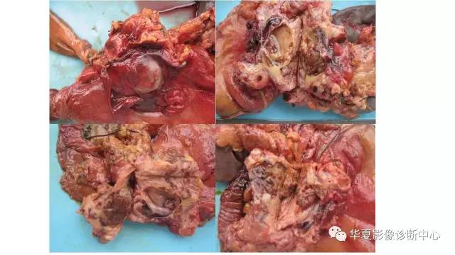 【病例】胰腺癌伴囊变坏死1例CT影像表现