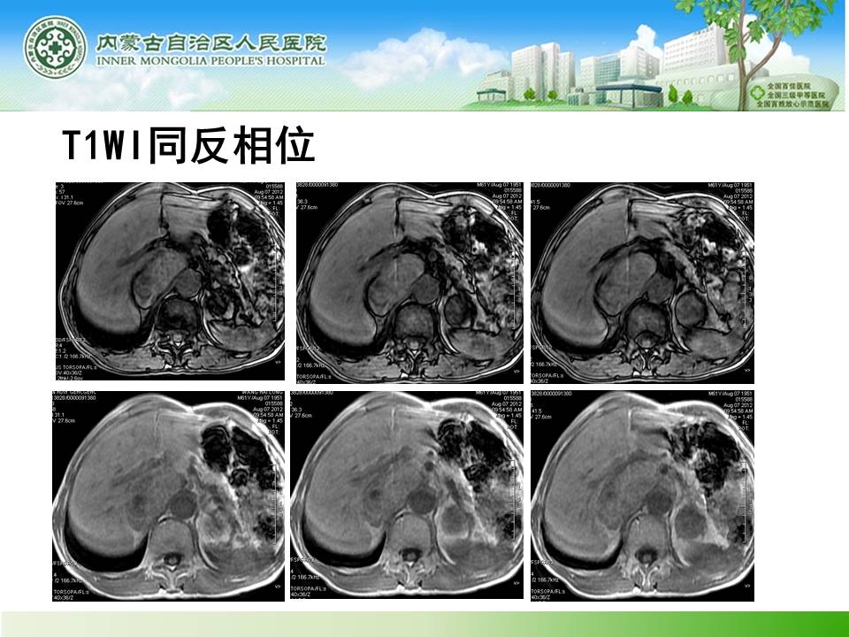 【病例】肾上腺嗜铬细胞瘤1例MR