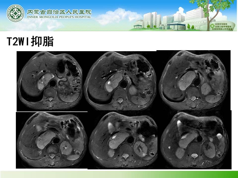 【病例】肾上腺嗜铬细胞瘤1例MR
