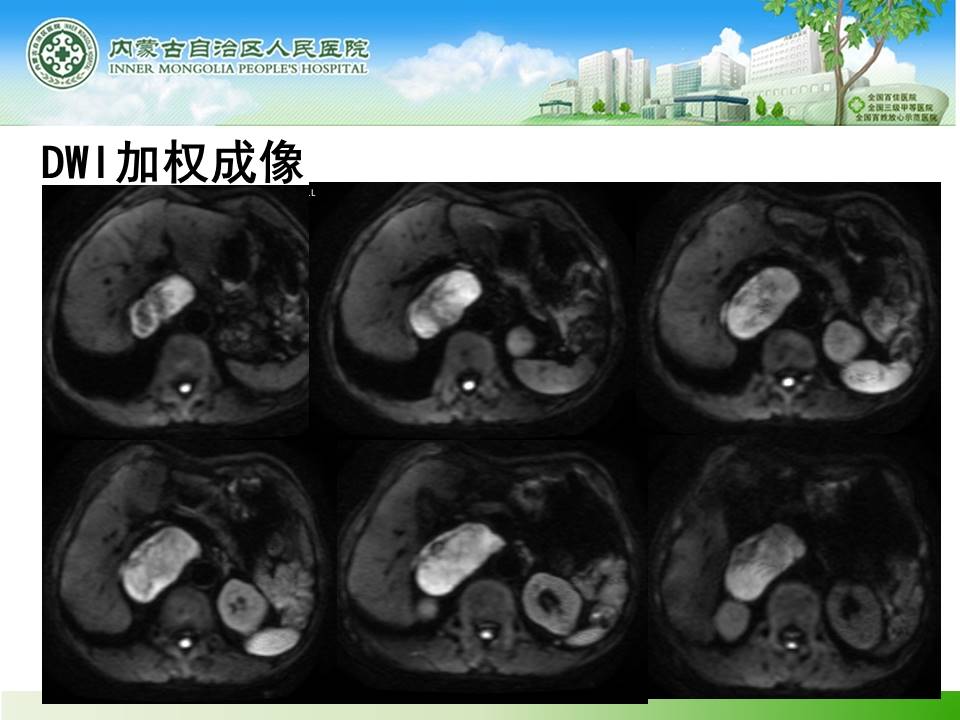 【病例】肾上腺嗜铬细胞瘤1例MR