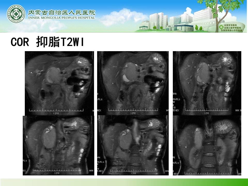 【病例】肾上腺嗜铬细胞瘤1例MR