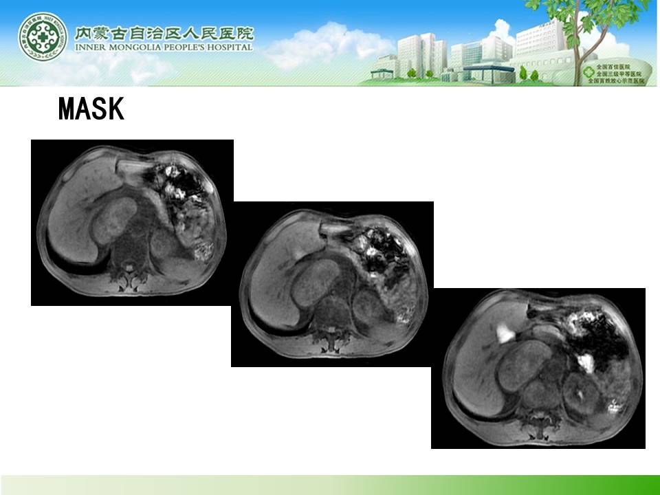 【病例】肾上腺嗜铬细胞瘤1例MR