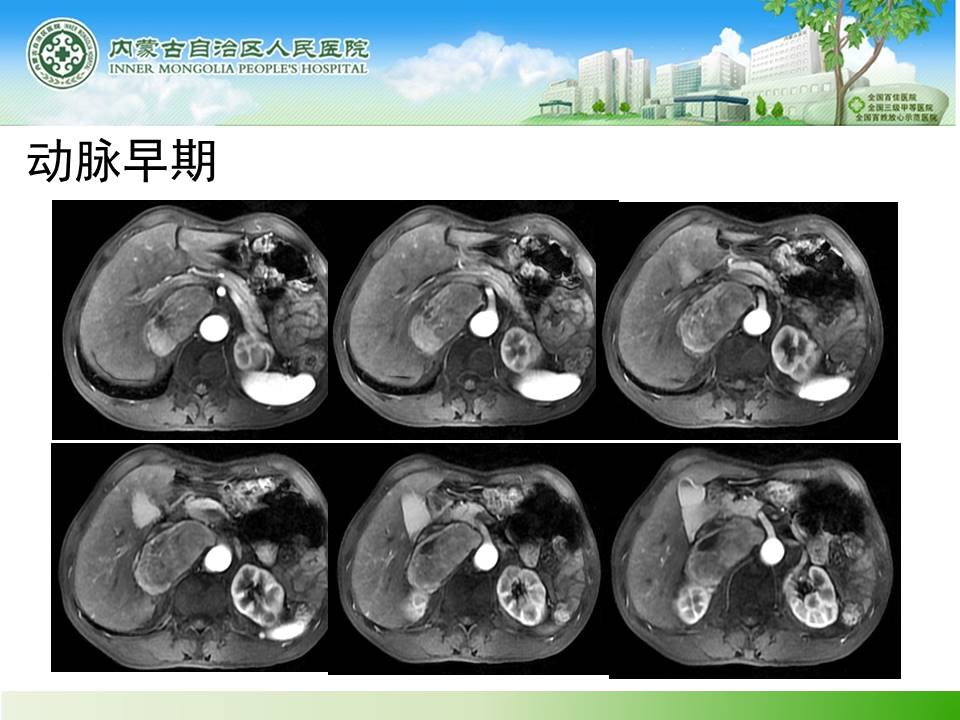 【病例】肾上腺嗜铬细胞瘤1例MR