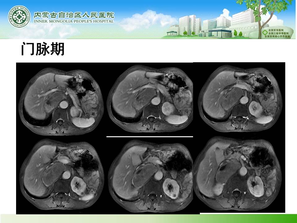 【病例】肾上腺嗜铬细胞瘤1例MR