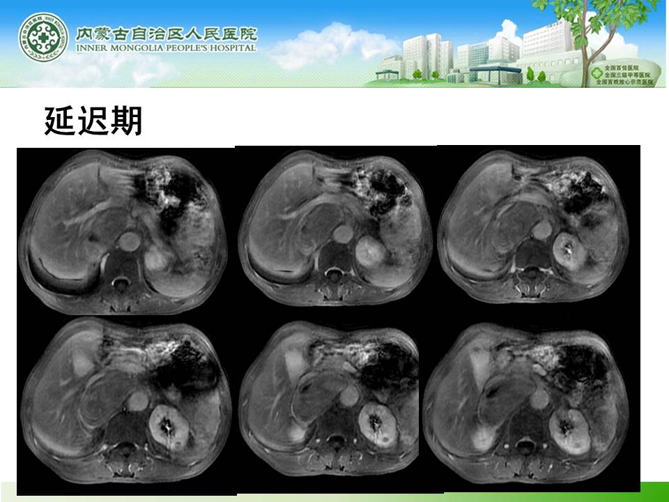 【病例】肾上腺嗜铬细胞瘤1例MR