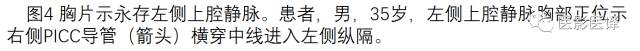 上腔静脉全面影像学回顾 上腔静脉全面影像学回顾