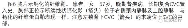 上腔静脉全面影像学回顾 上腔静脉全面影像学回顾