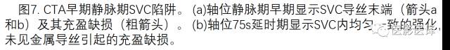 上腔静脉全面影像学回顾 上腔静脉全面影像学回顾