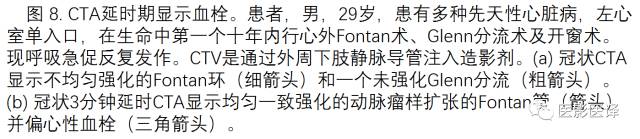 上腔静脉全面影像学回顾 上腔静脉全面影像学回顾
