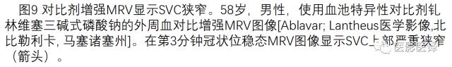 上腔静脉全面影像学回顾 上腔静脉全面影像学回顾