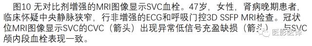 上腔静脉全面影像学回顾 上腔静脉全面影像学回顾