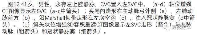 上腔静脉全面影像学回顾 上腔静脉全面影像学回顾