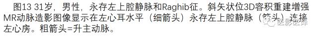 上腔静脉全面影像学回顾 上腔静脉全面影像学回顾