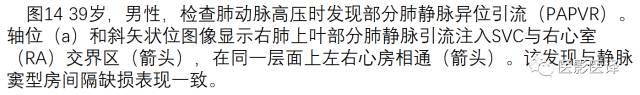 上腔静脉全面影像学回顾 上腔静脉全面影像学回顾